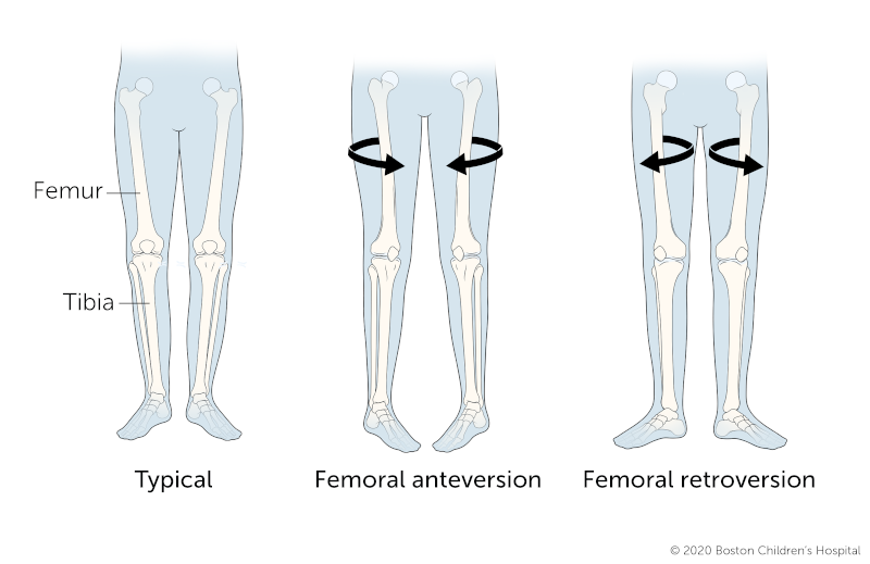 Not All Hips are Created the Same Hip Anteversion and Retroversion